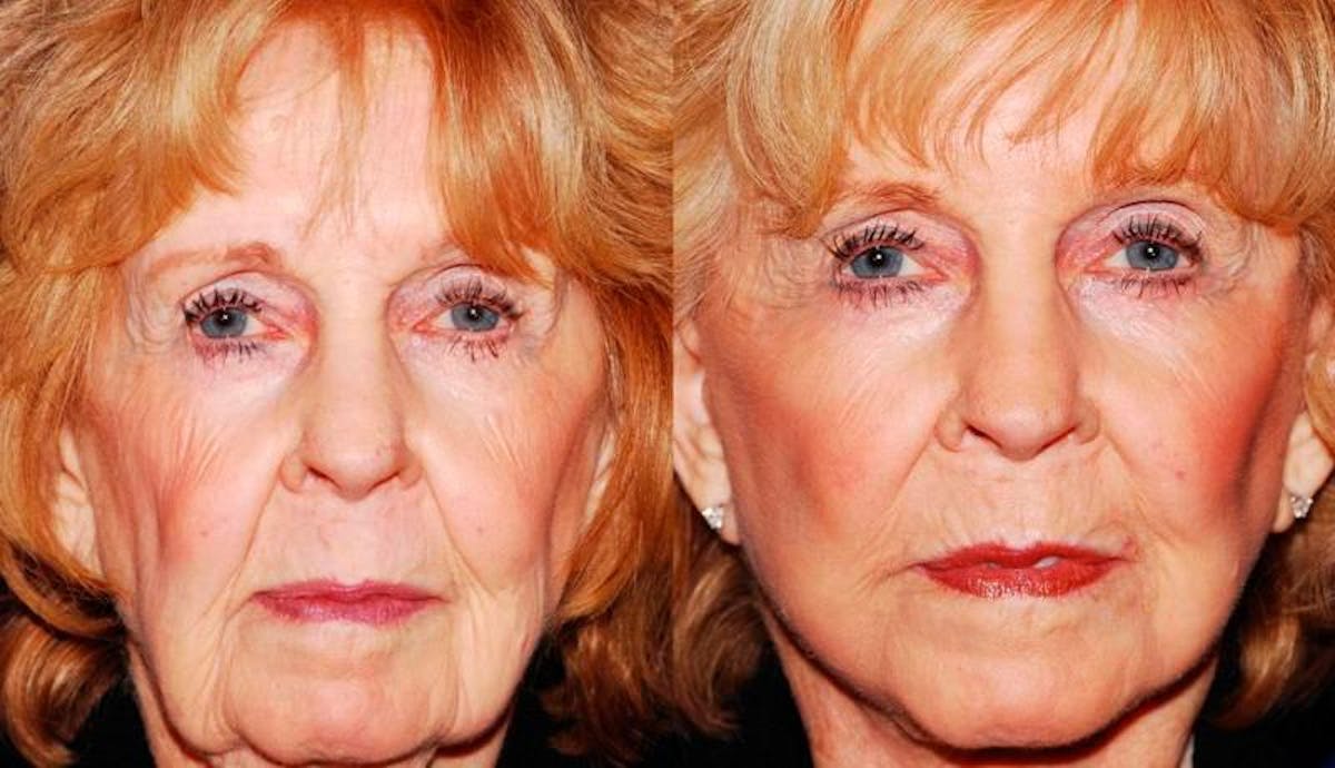 Facelift Before & After Gallery - Patient 255304 - Image 1