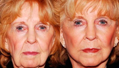 Facelift Before & After Gallery - Patient 255304 - Image 1