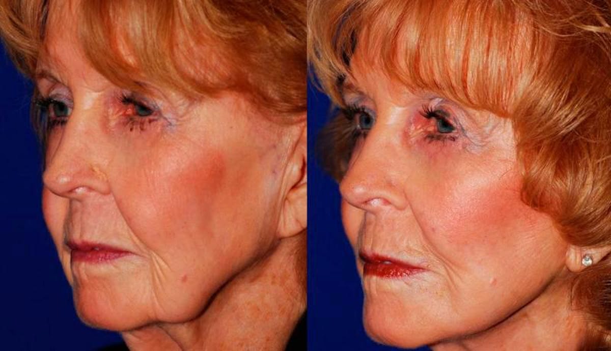 Facelift Before & After Gallery - Patient 255304 - Image 2
