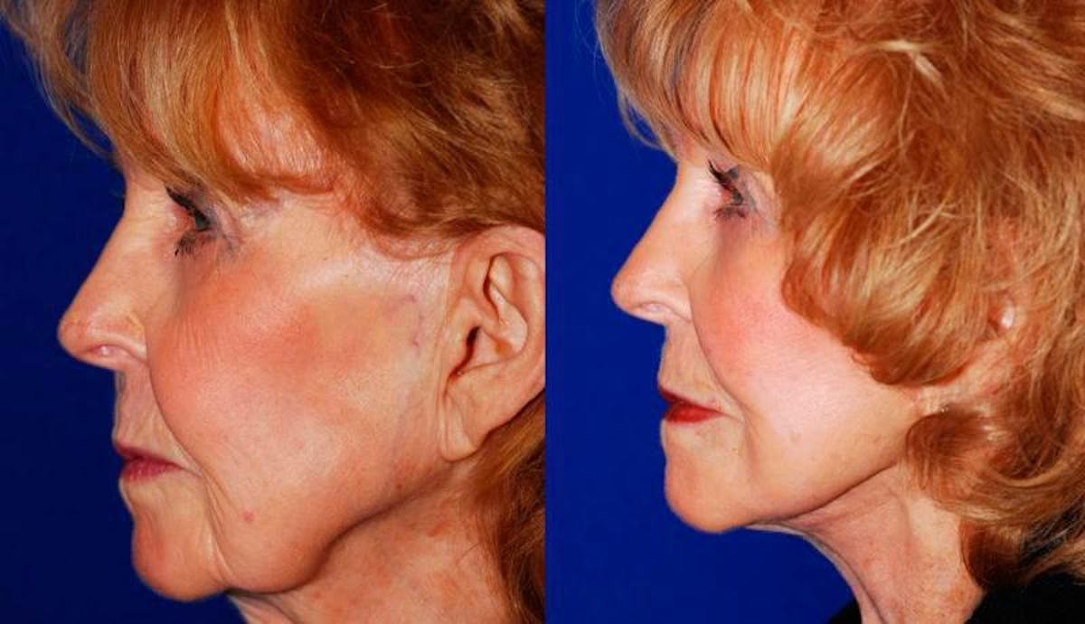 Facelift Before & After Gallery - Patient 255304 - Image 3