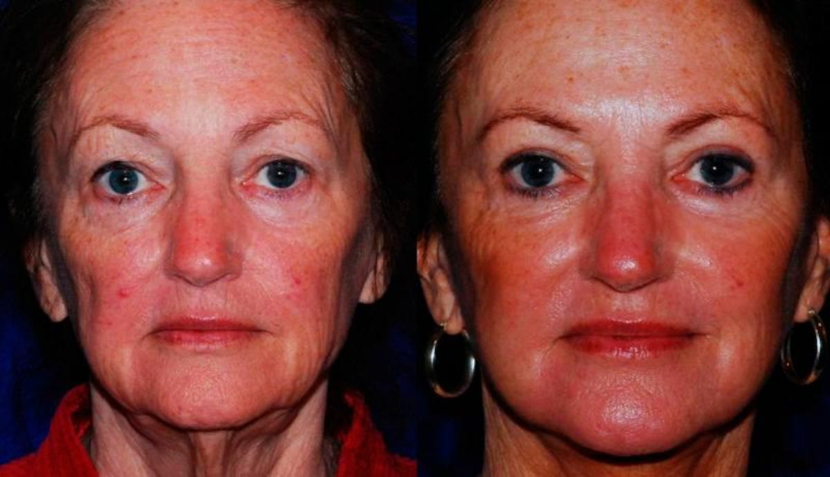 Facelift Before & After Gallery - Patient 208928 - Image 1