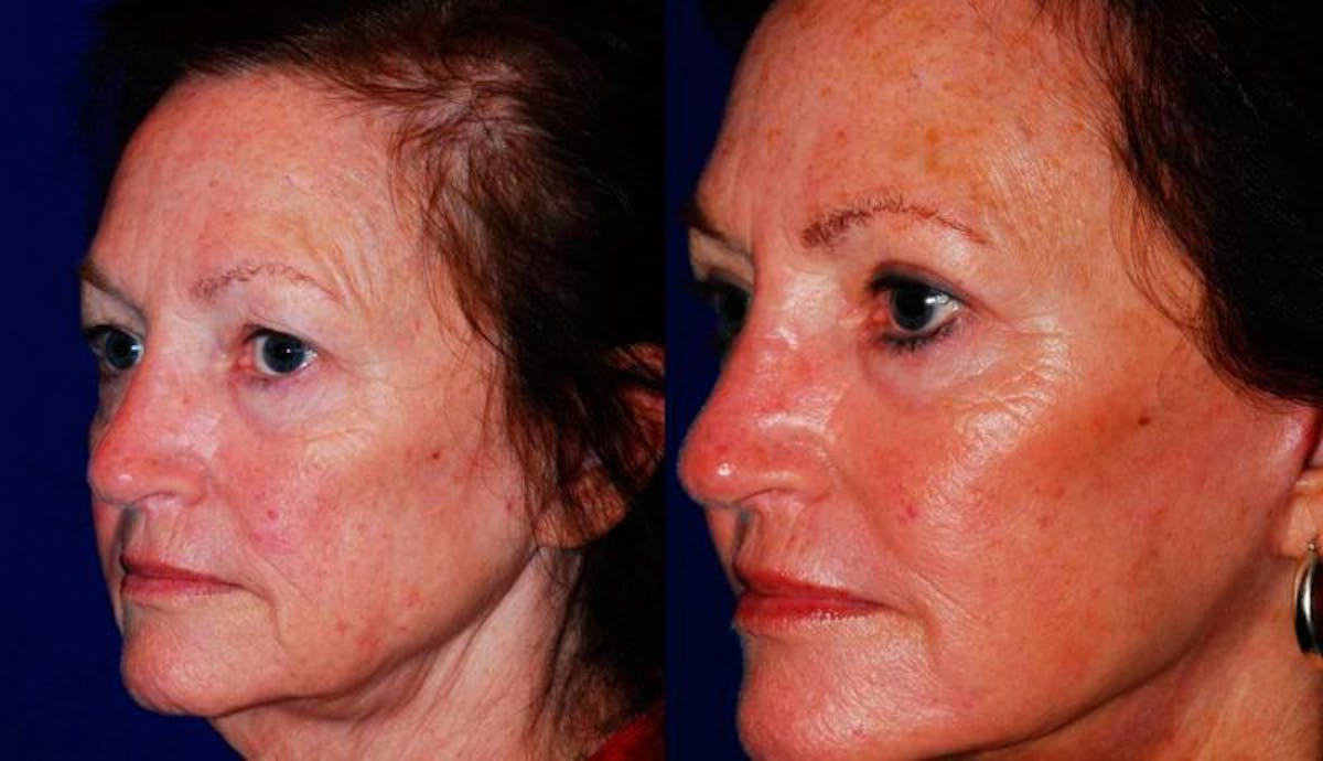 Facelift Before & After Gallery - Patient 208928 - Image 2