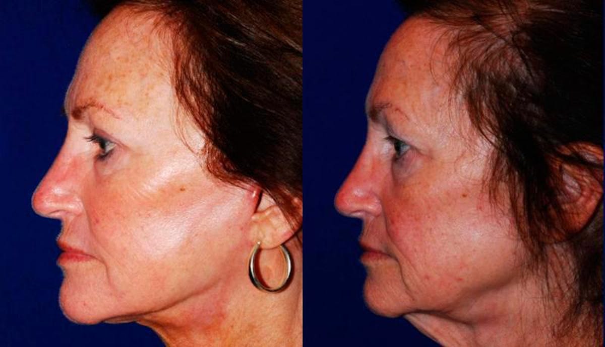 Facelift Before & After Gallery - Patient 208928 - Image 3
