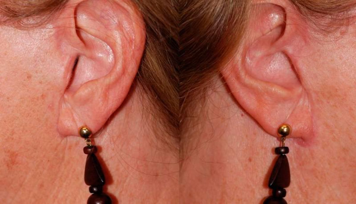 Facelift Before & After Gallery - Patient 292956 - Image 1