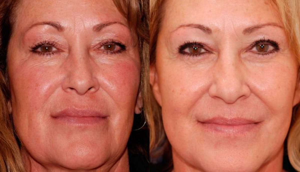 Facelift Before & After Gallery - Patient 429359 - Image 1