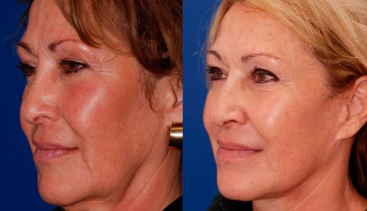 Facelift Before & After Gallery - Patient 429359 - Image 2