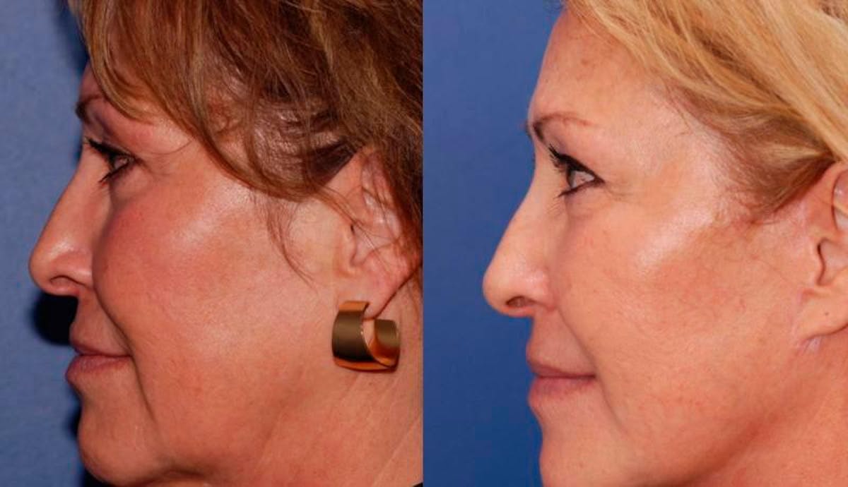 Facelift Before & After Gallery - Patient 429359 - Image 3