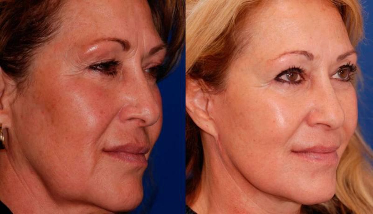 Facelift Before & After Gallery - Patient 429359 - Image 4