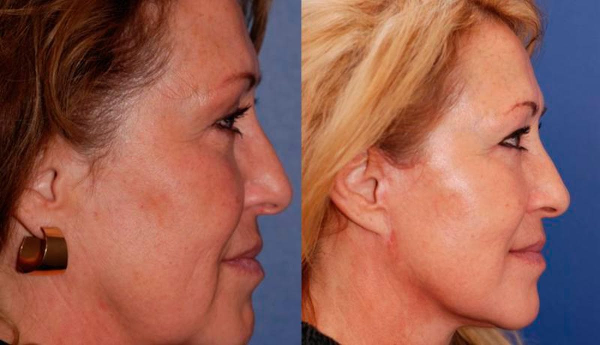 Facelift Before & After Gallery - Patient 429359 - Image 5