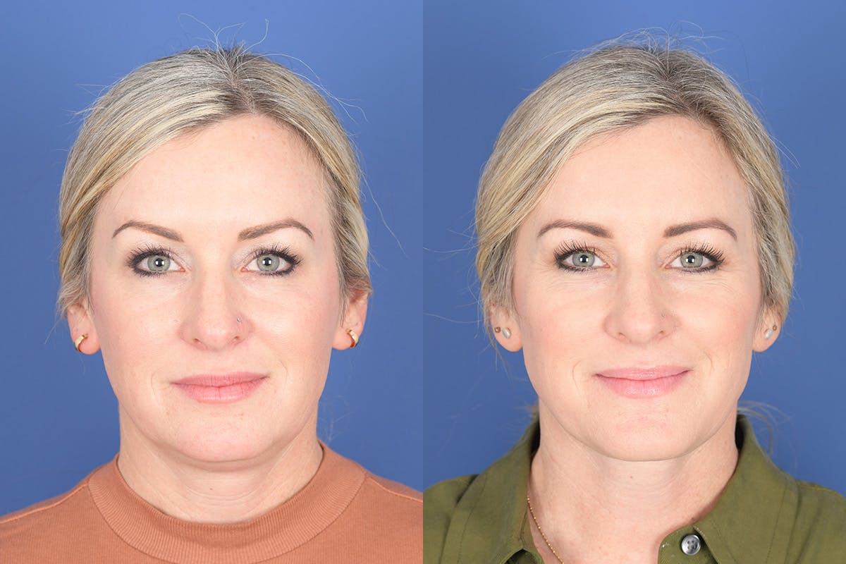 Necklift Before & After Gallery - Patient 273235 - Image 1