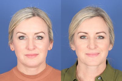 Necklift Before & After Gallery - Patient 273235 - Image 1