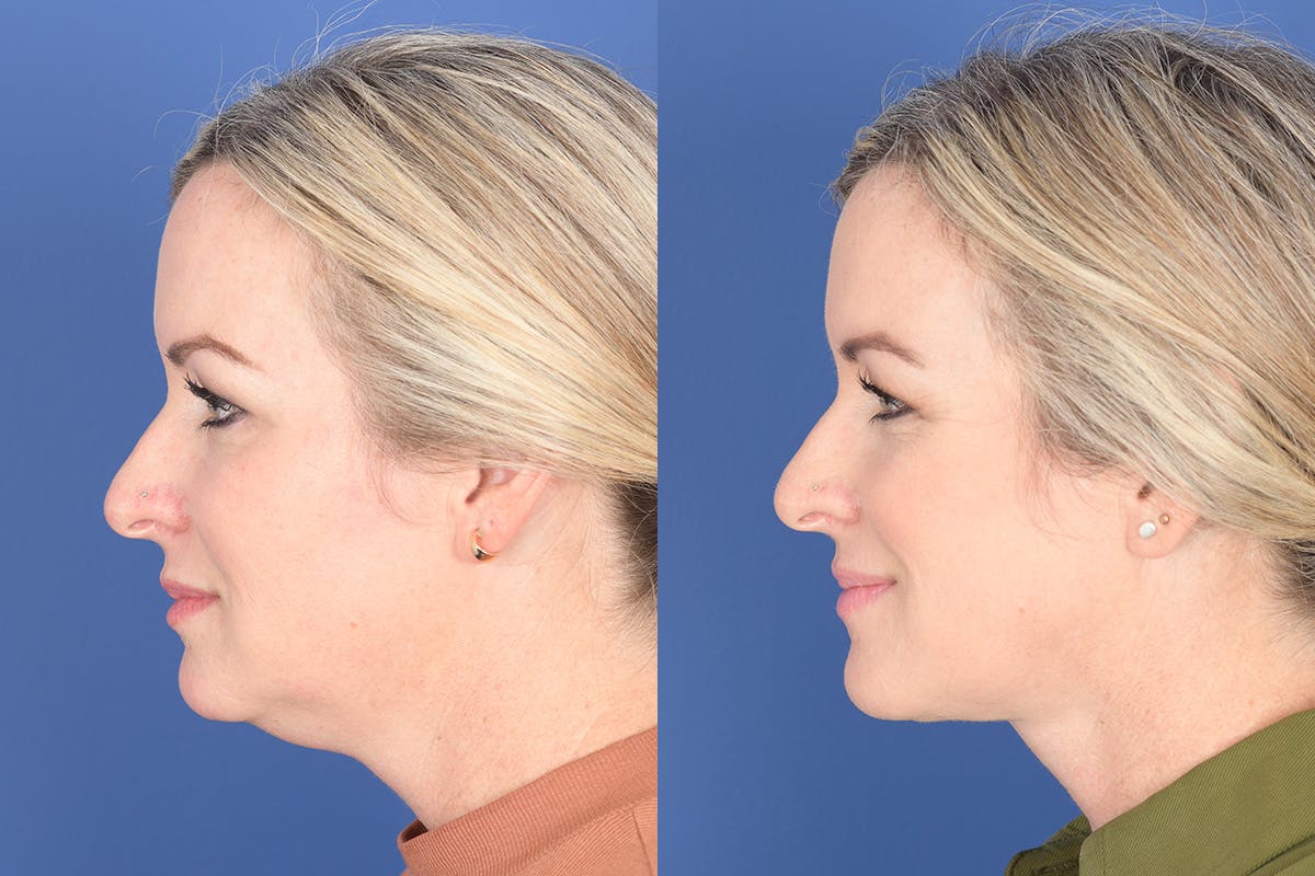 Necklift Before & After Gallery - Patient 273235 - Image 2