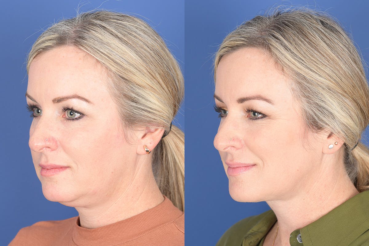 Necklift Before & After Gallery - Patient 273235 - Image 3