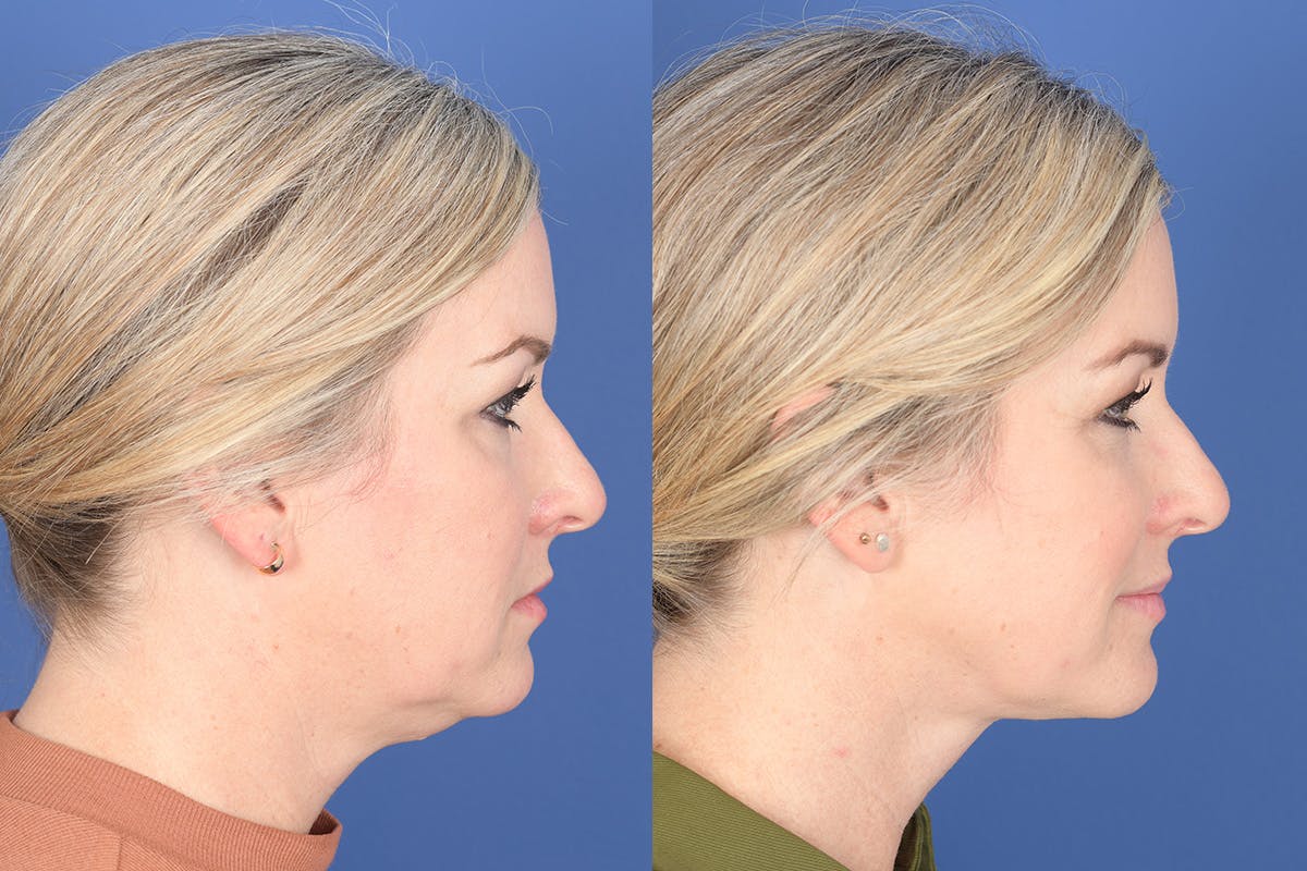 Necklift Before & After Gallery - Patient 273235 - Image 4