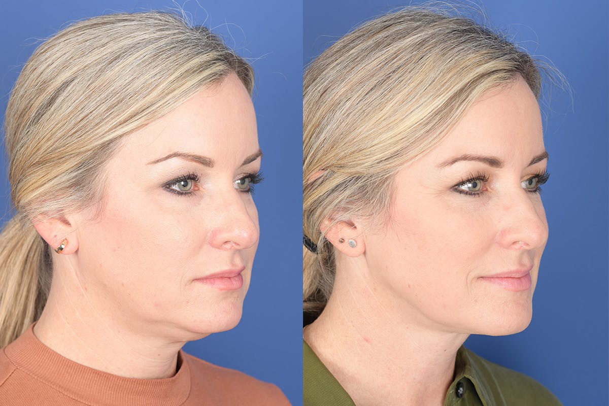 Necklift Before & After Gallery - Patient 273235 - Image 5