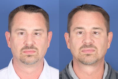 Necklift Before & After Gallery - Patient 126515 - Image 1