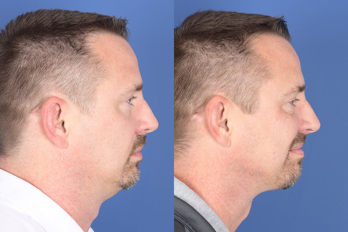 Necklift Before & After Gallery - Patient 126515 - Image 2