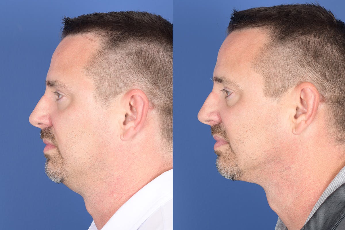 Necklift Before & After Gallery - Patient 126515 - Image 3