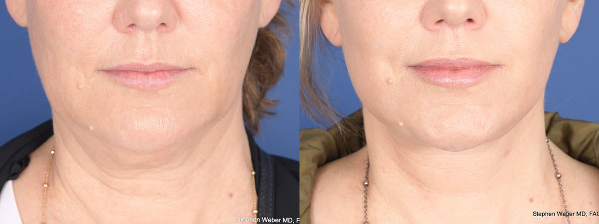 Necklift Before & After Gallery - Patient 338060 - Image 1