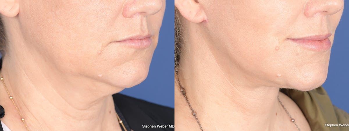 Necklift Before & After Gallery - Patient 338060 - Image 2