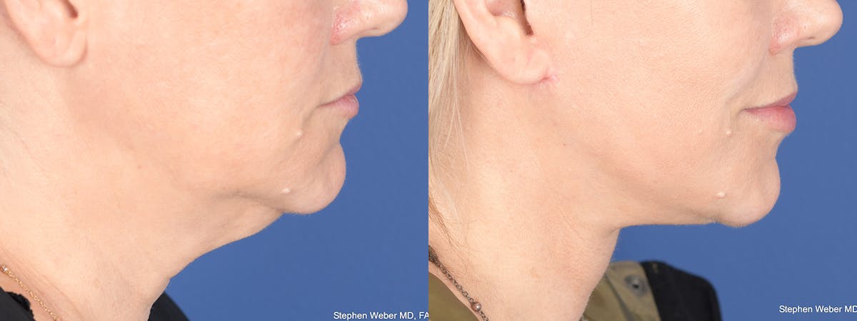 Necklift Before & After Gallery - Patient 338060 - Image 3