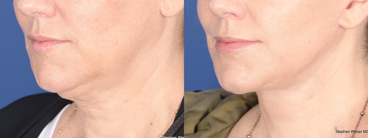 Necklift Before & After Gallery - Patient 338060 - Image 4