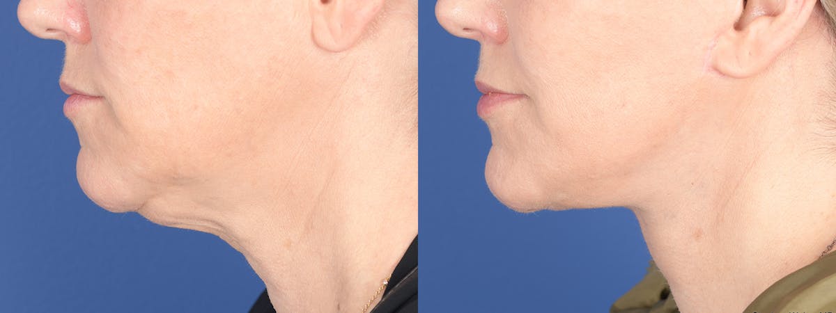 Necklift Before & After Gallery - Patient 338060 - Image 5