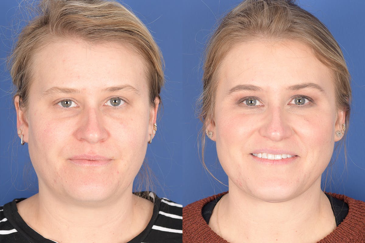 Necklift Before & After Gallery - Patient 272842 - Image 1