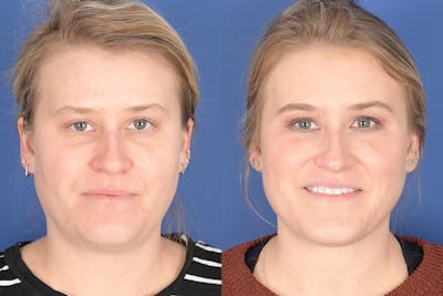 Necklift Before & After Gallery - Patient 272842 - Image 1