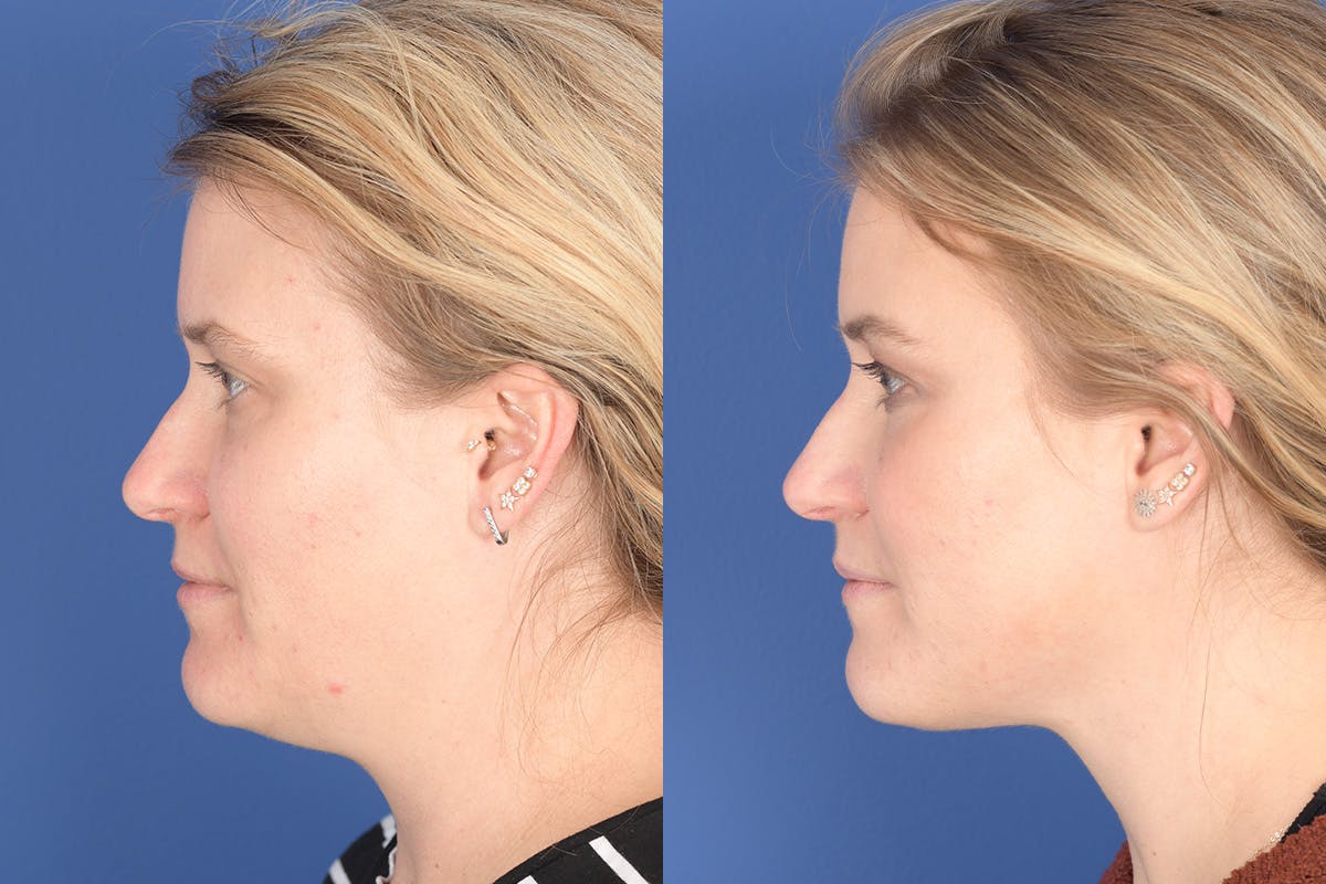 Necklift Before & After Gallery - Patient 272842 - Image 2