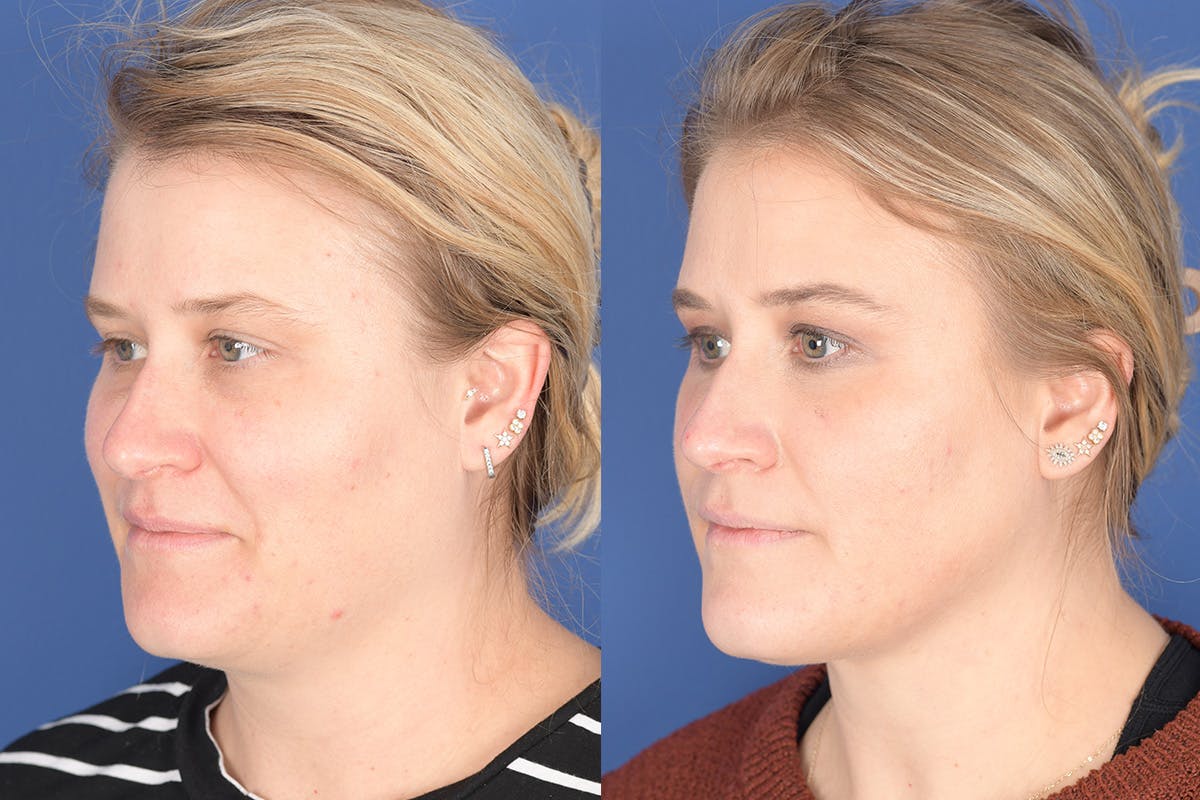 Necklift Before & After Gallery - Patient 272842 - Image 3