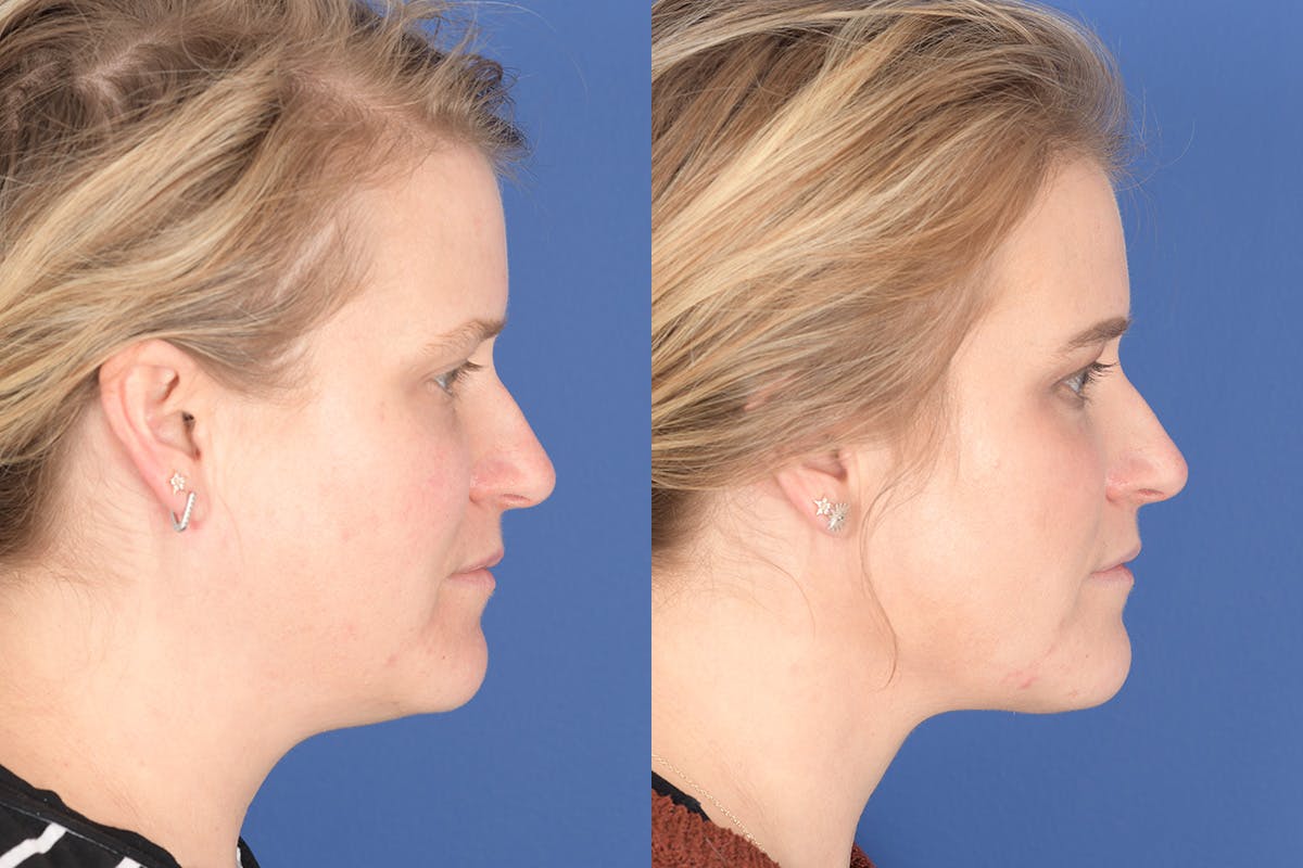 Necklift Before & After Gallery - Patient 272842 - Image 4