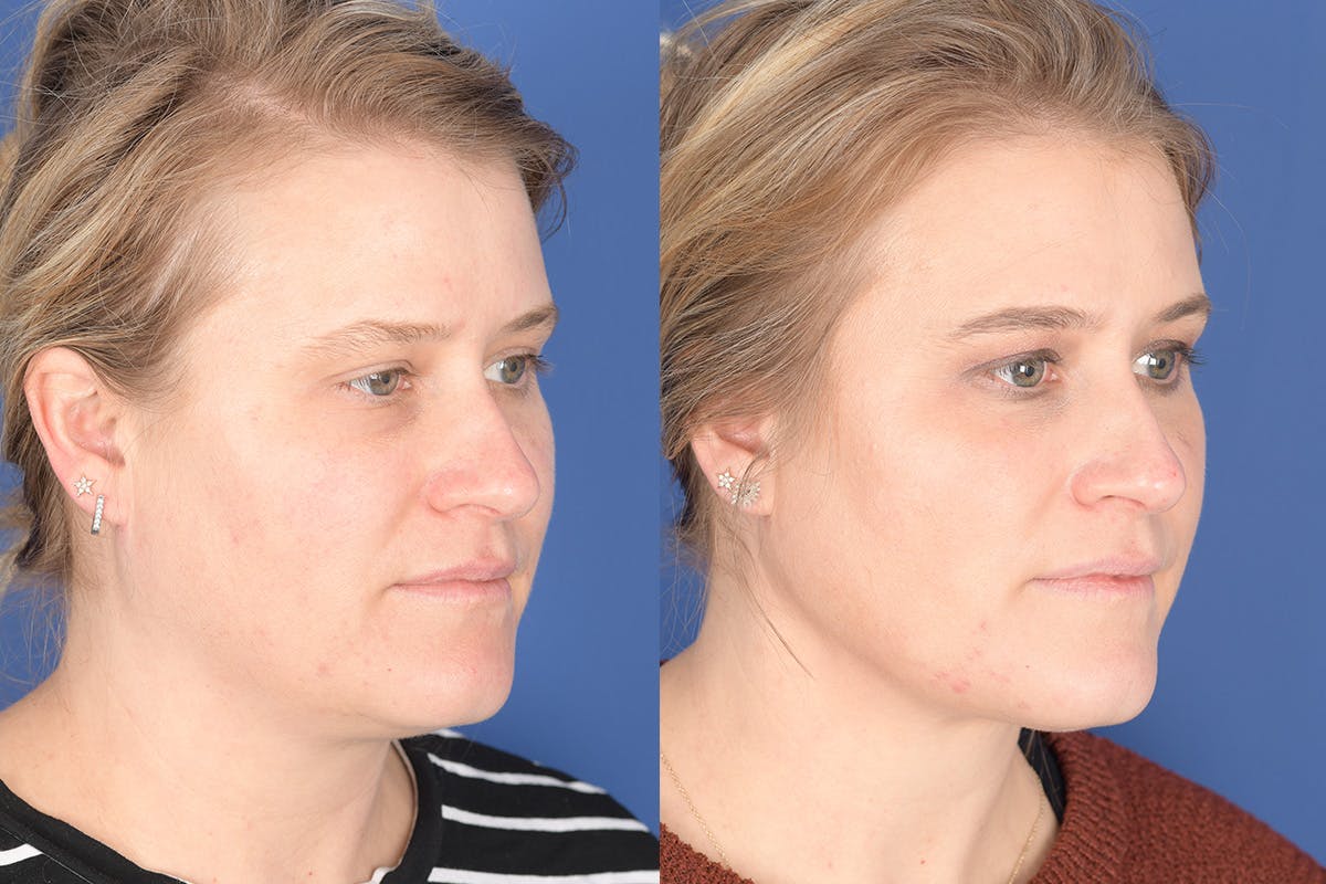 Necklift Before & After Gallery - Patient 272842 - Image 5