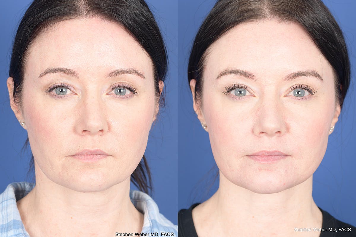 Necklift Before & After Gallery - Patient 184932 - Image 1