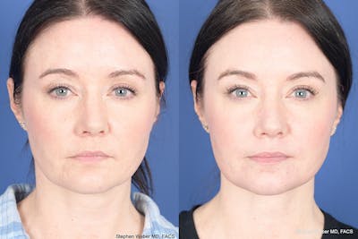 Necklift Before & After Gallery - Patient 184932 - Image 1