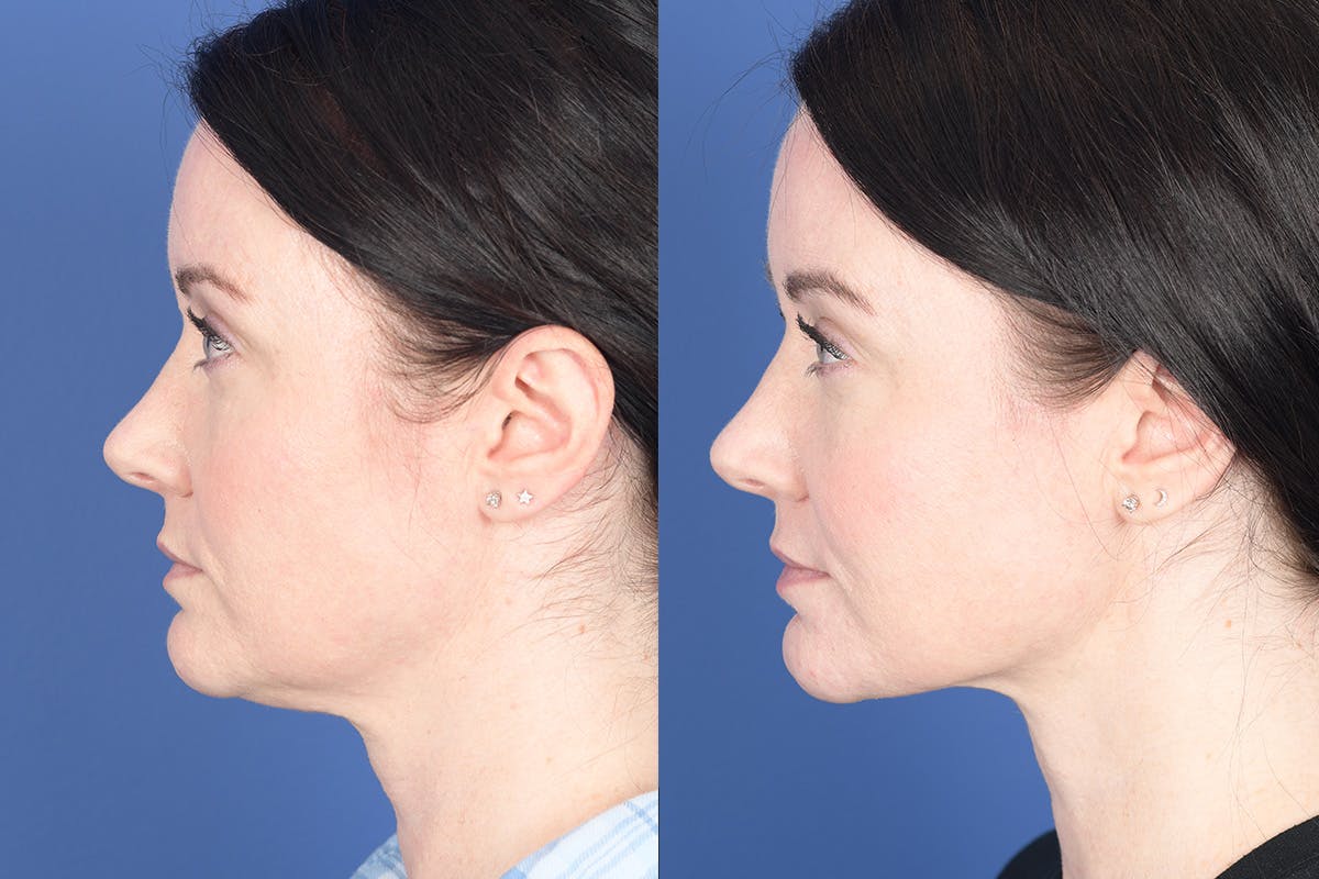 Necklift Before & After Gallery - Patient 184932 - Image 2
