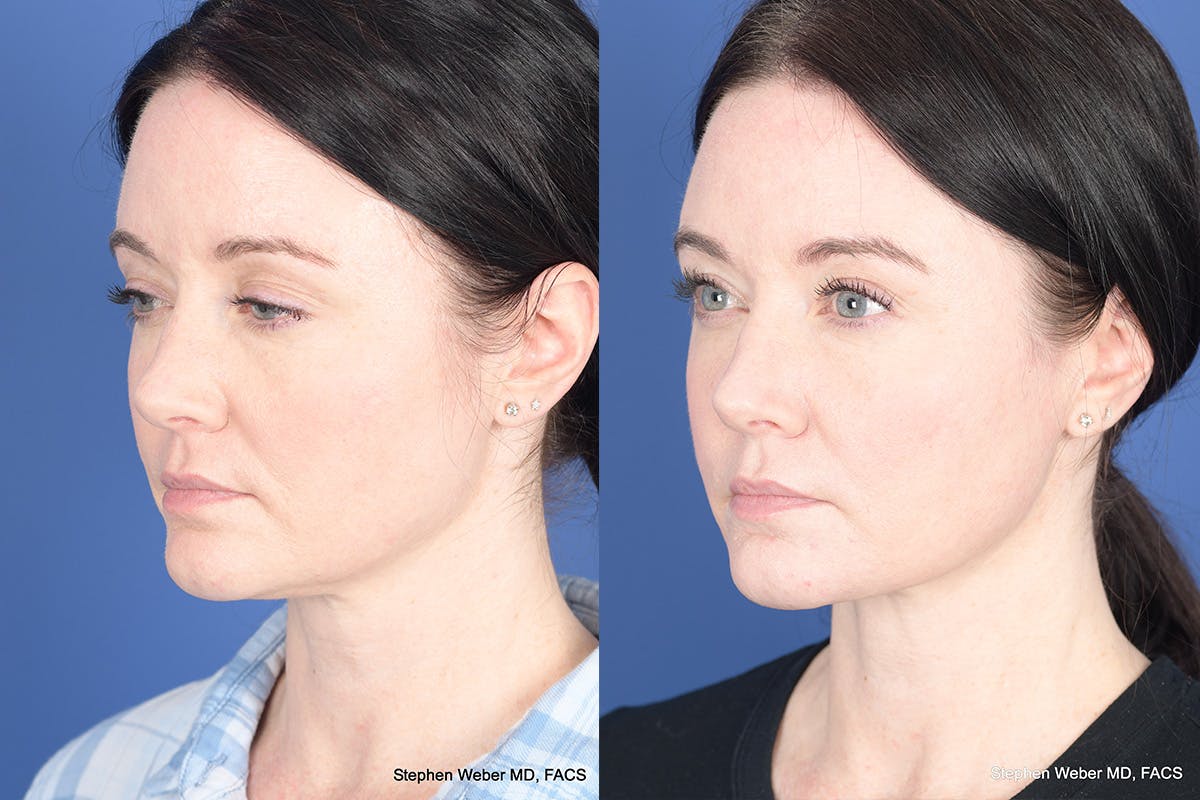 Necklift Before & After Gallery - Patient 184932 - Image 3