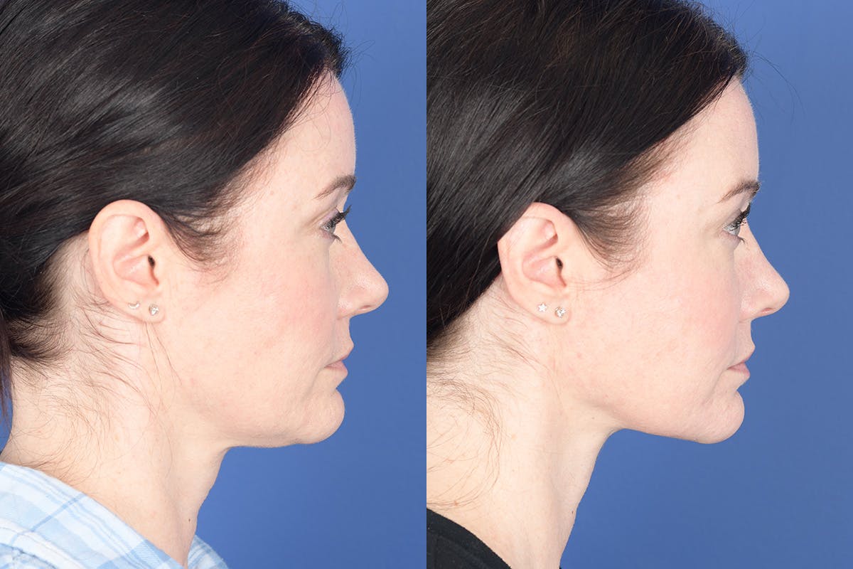 Necklift Before & After Gallery - Patient 184932 - Image 4