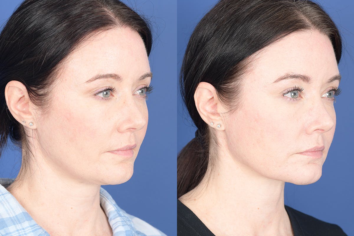 Necklift Before & After Gallery - Patient 184932 - Image 5