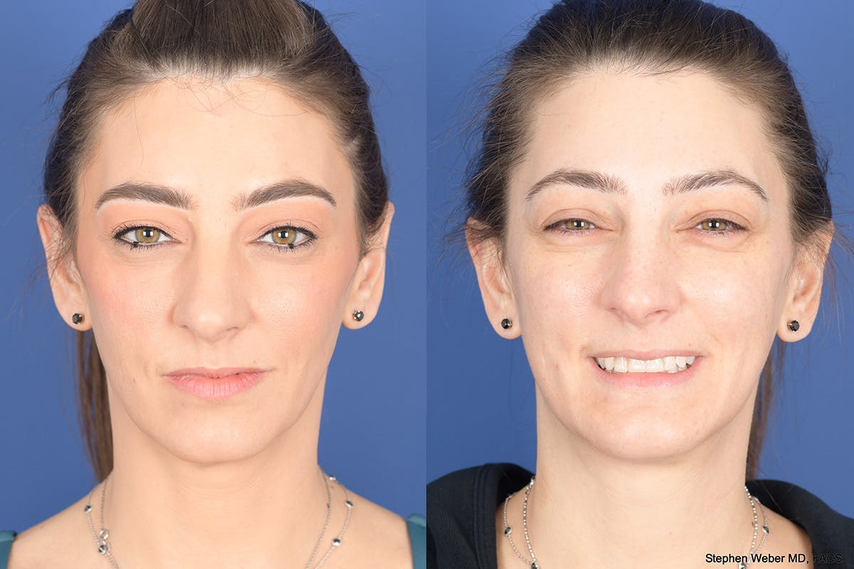 Necklift Before & After Gallery - Patient 195696 - Image 1