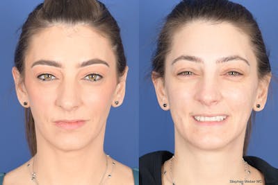 Necklift Before & After Gallery - Patient 195696 - Image 1