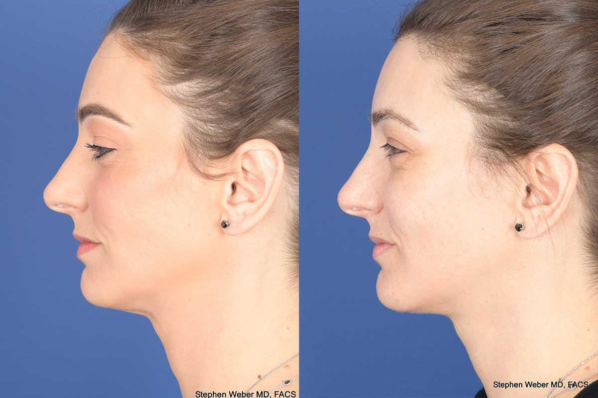 Necklift Before & After Gallery - Patient 195696 - Image 2