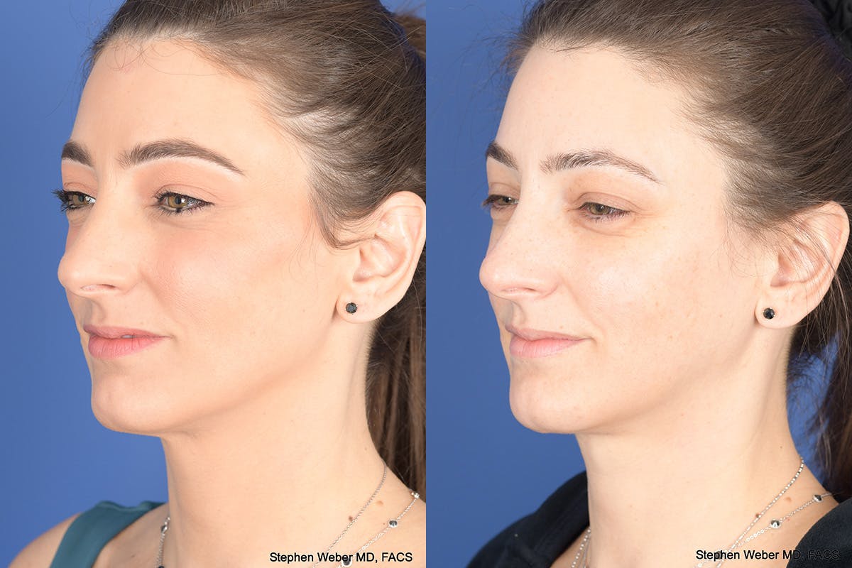 Necklift Before & After Gallery - Patient 195696 - Image 3