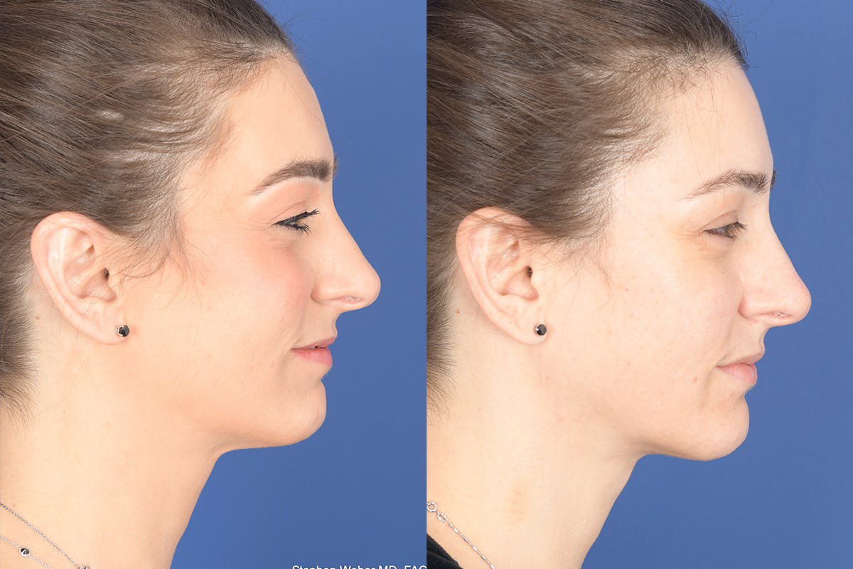 Necklift Before & After Gallery - Patient 195696 - Image 4