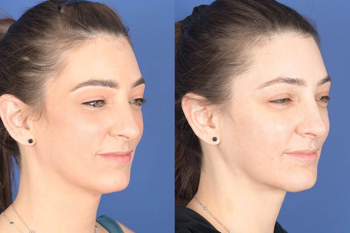 Necklift Before & After Gallery - Patient 195696 - Image 5