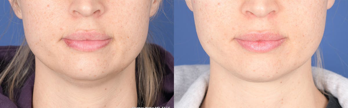 Necklift Before & After Gallery - Patient 193996 - Image 1