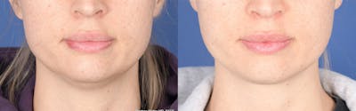 Necklift Before & After Gallery - Patient 193996 - Image 1