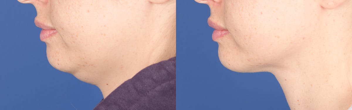 Necklift Before & After Gallery - Patient 193996 - Image 2