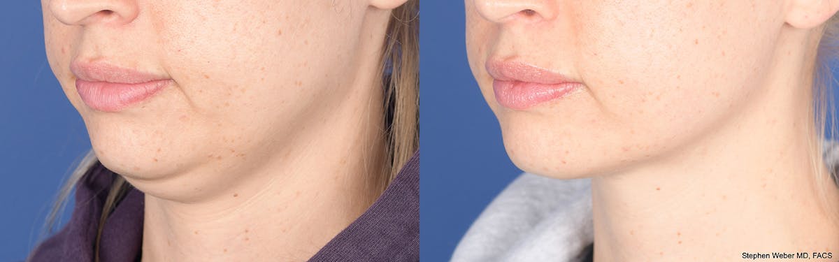 Necklift Before & After Gallery - Patient 193996 - Image 3