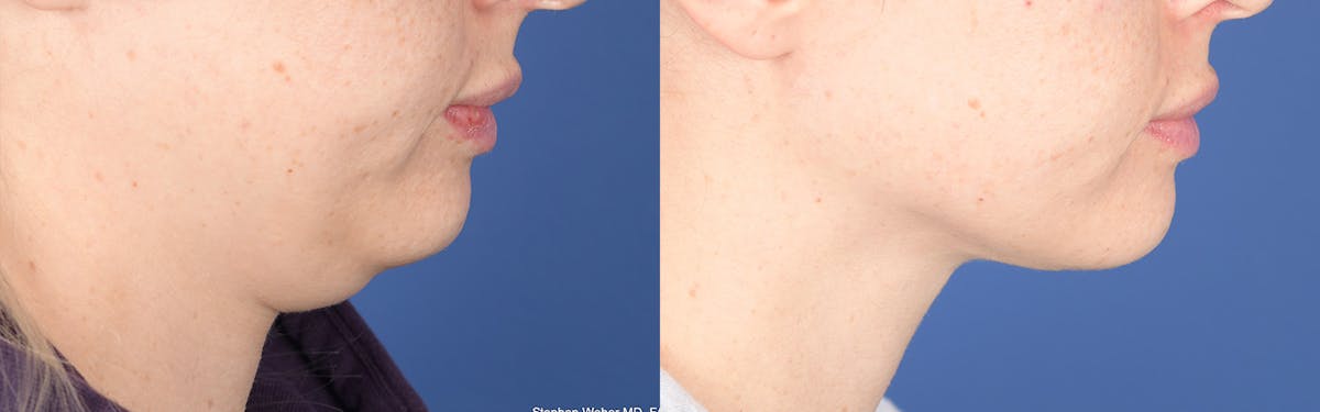 Necklift Before & After Gallery - Patient 193996 - Image 4